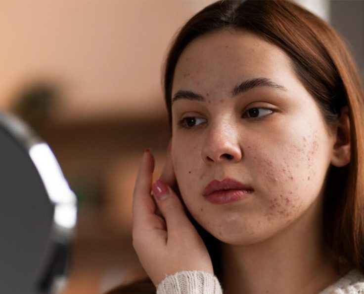Acne scar and acne treatment